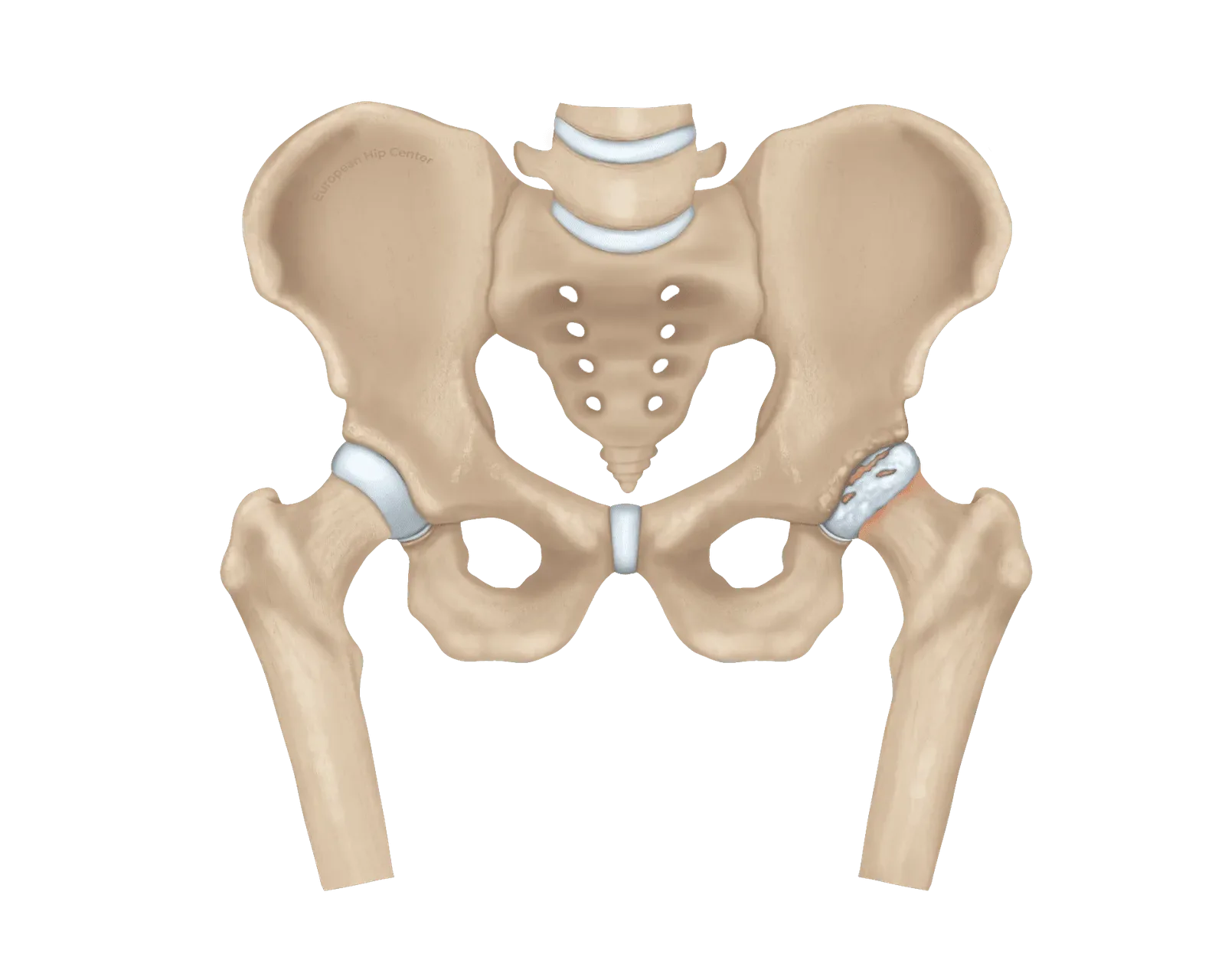 Anatomische illustratie van een bekken met artrose in de rechter heup