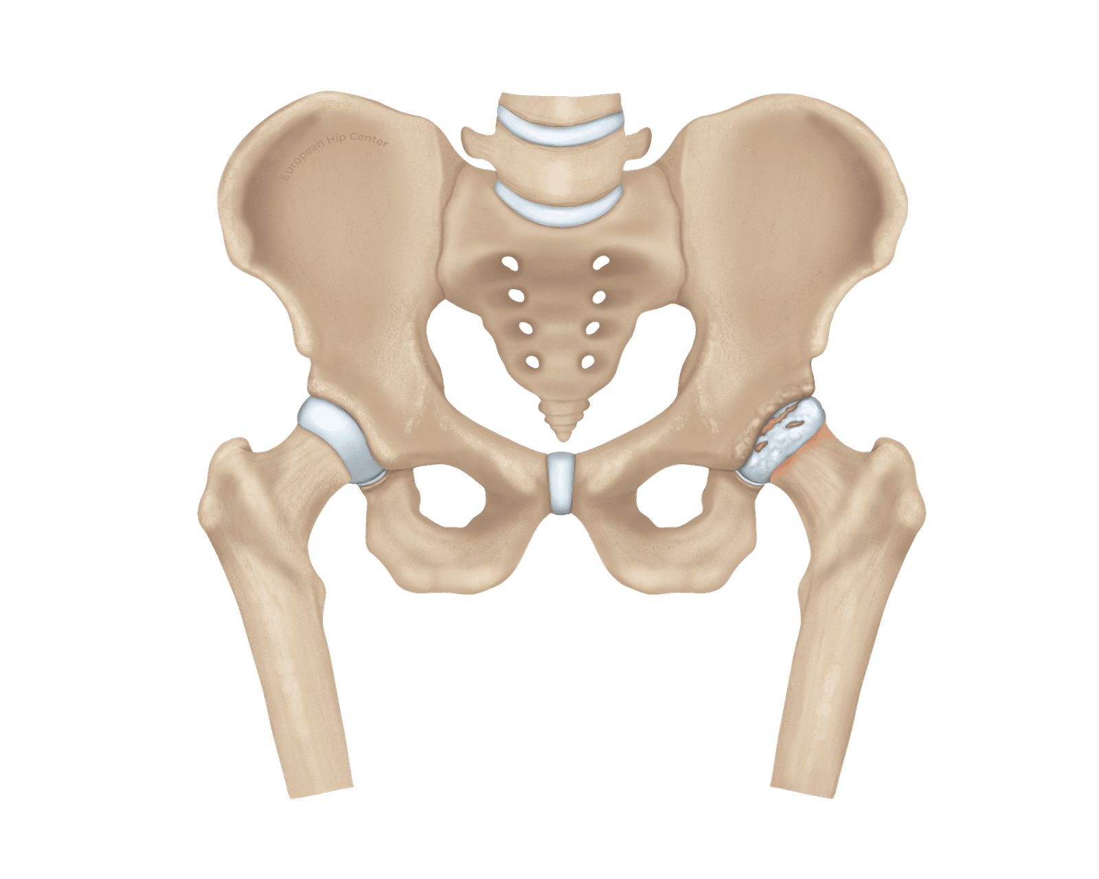 Anatomische illustratie van een bekken met artrose in de rechter heup